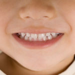 成長途中の子どもの顎骨を矯正する”顎顔面矯正法”とは